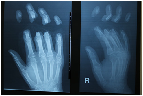 四個(gè)指頭多段離斷  我院手術(shù)18小時(shí)成功接活